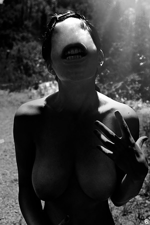 Underbite
